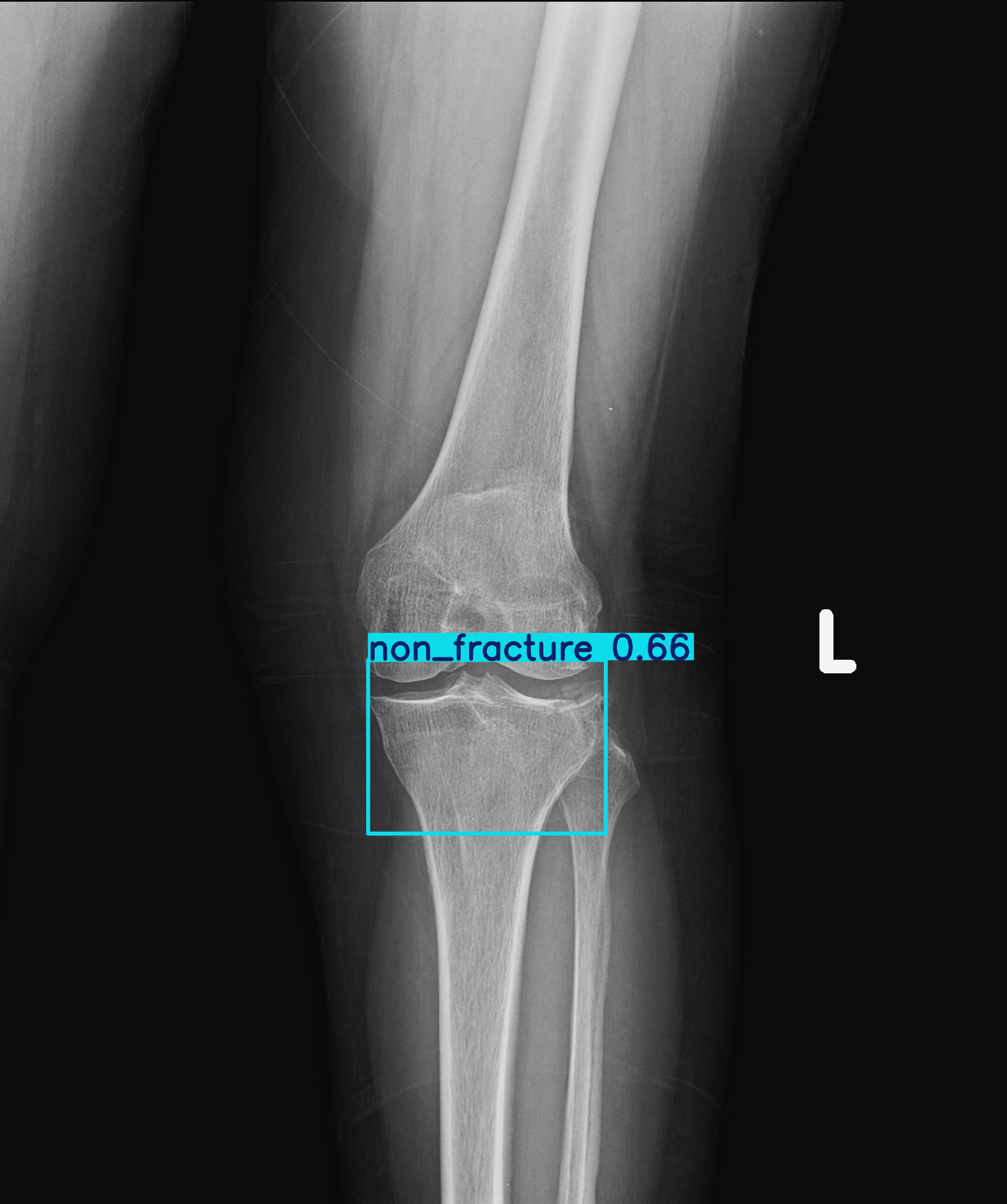 non_fracture_1-1.jpg