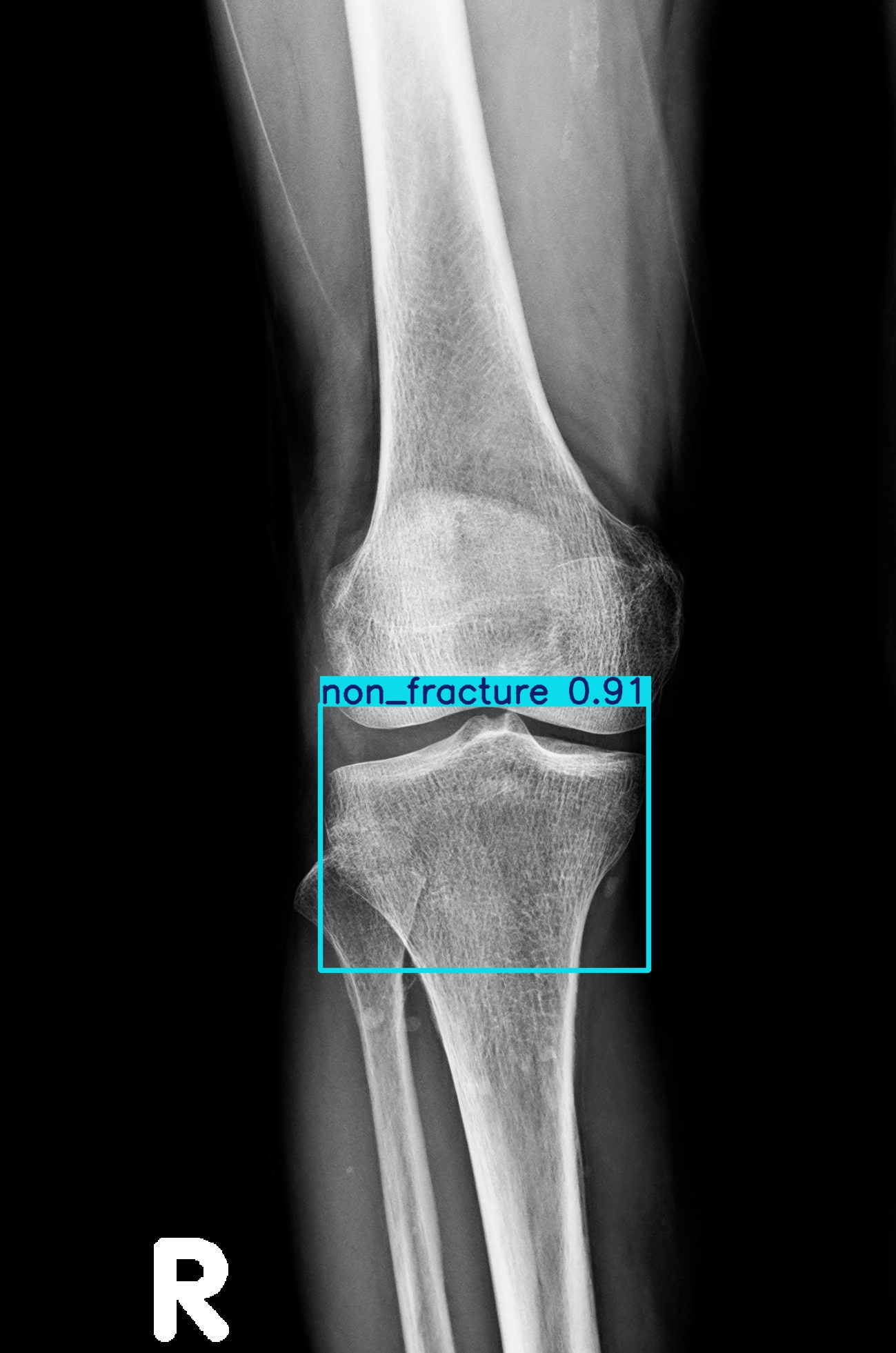 non_fracture_1.jpg