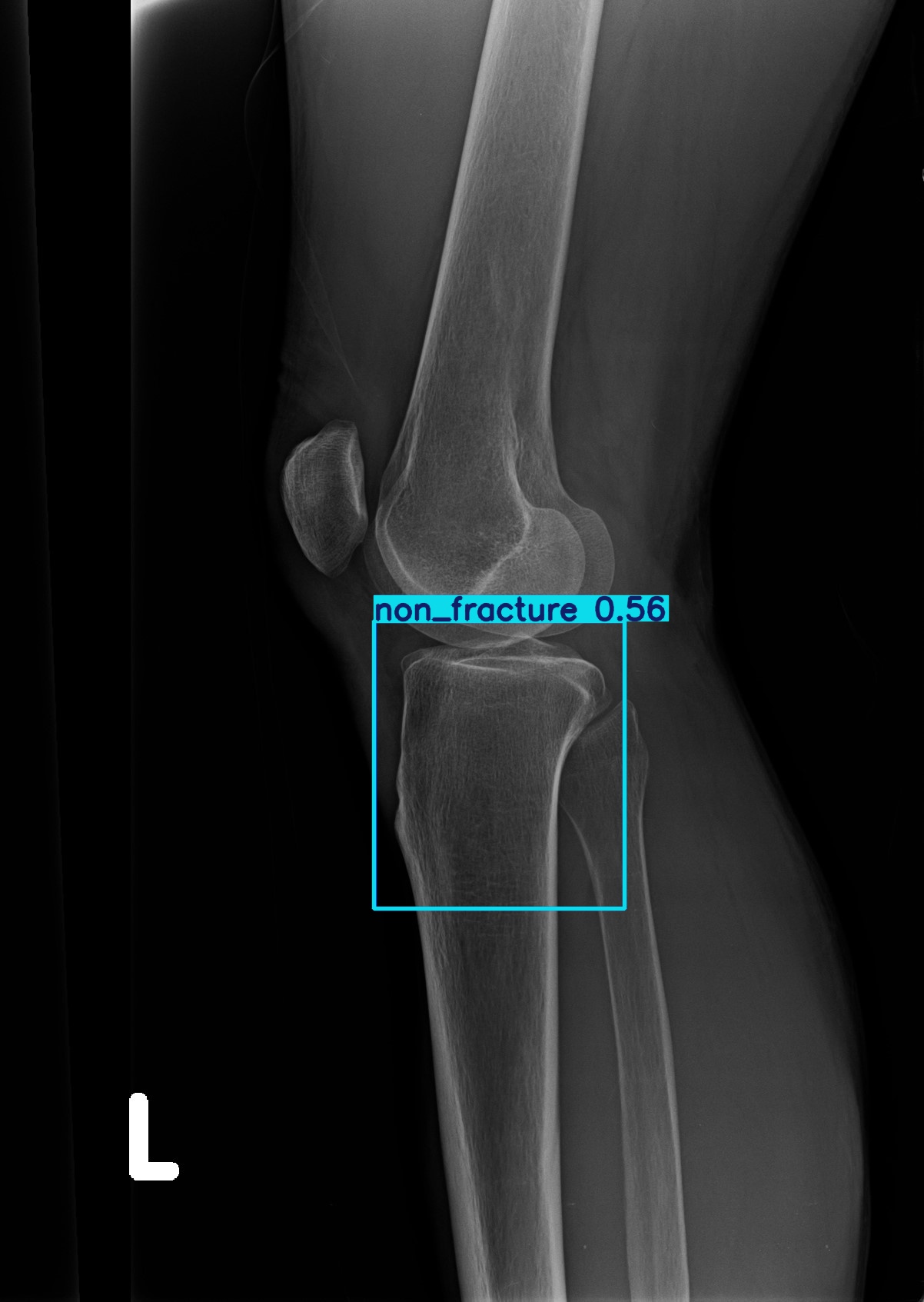 non_fracture_2.jpg