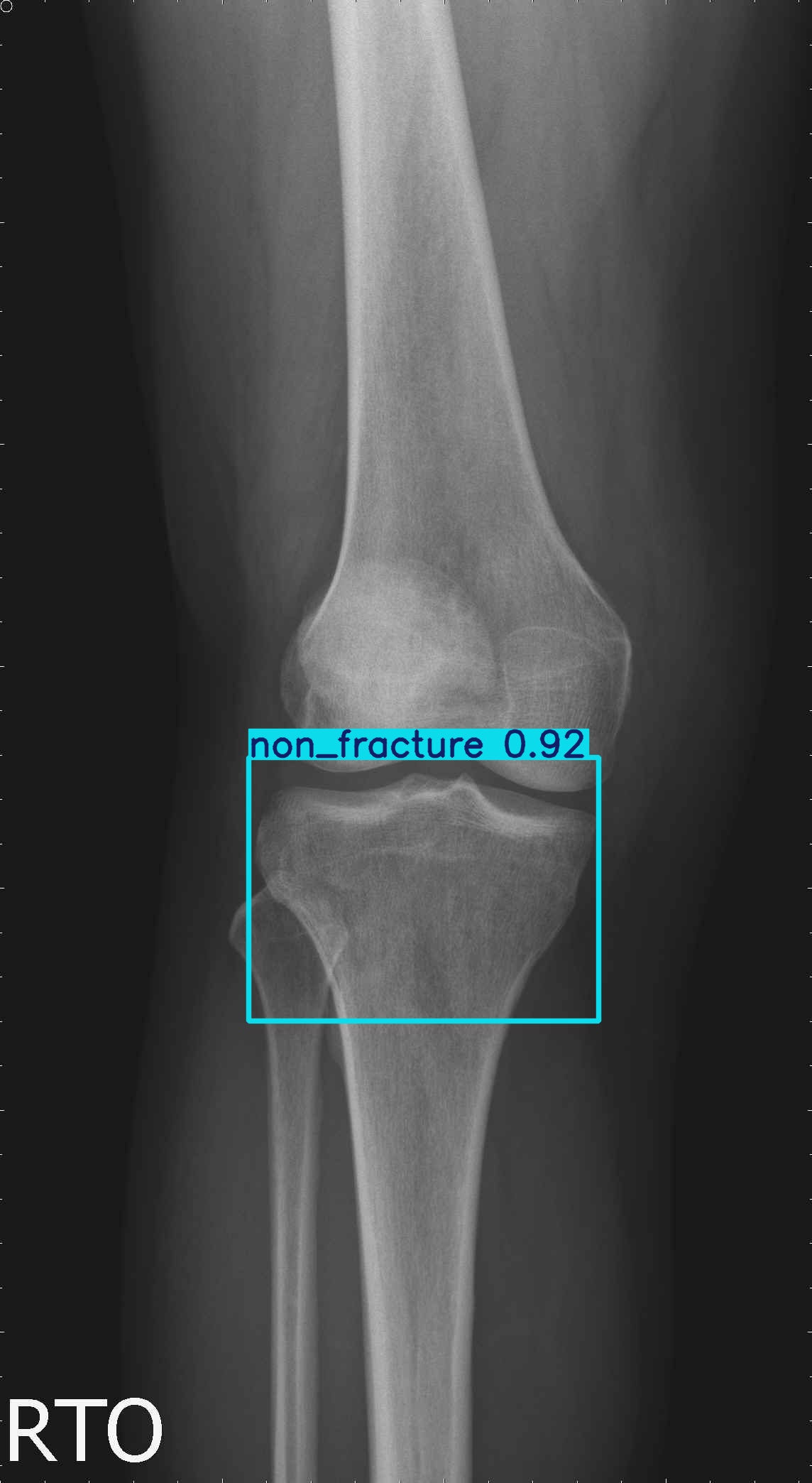 non_fracture_ap_5_1_1_1.jpg