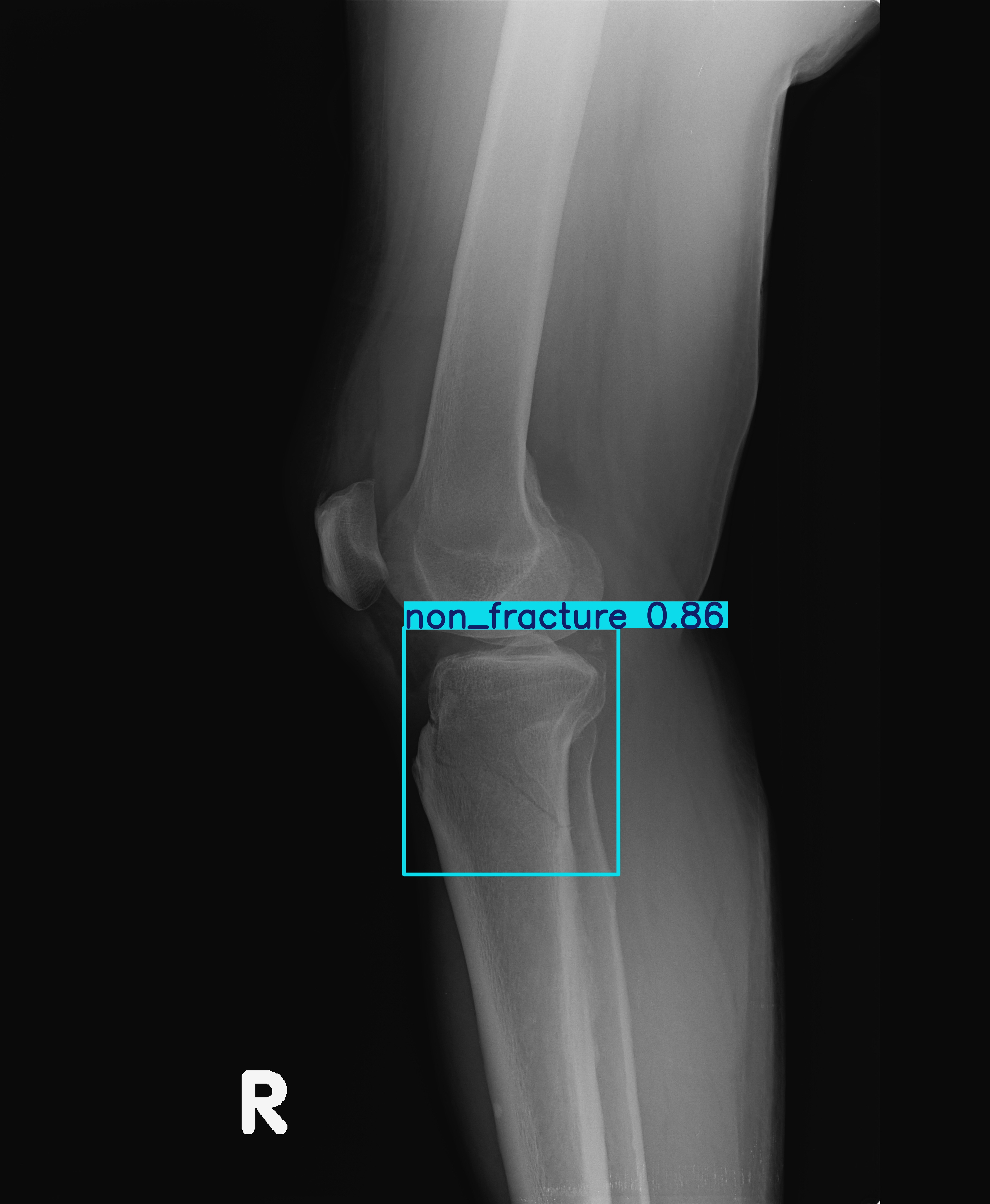 non_fracture_lateral_2-2.jpg