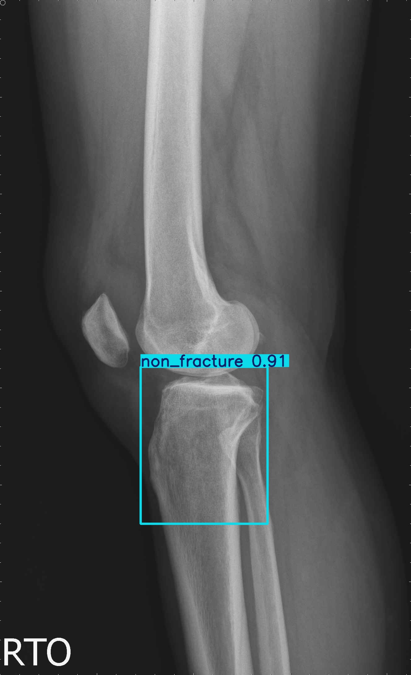 non_fracture_lateral_5_1_1_2.jpg