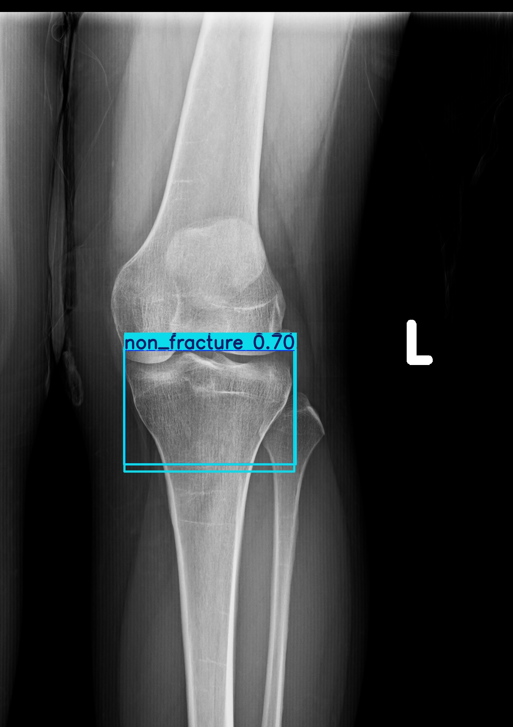non_fracture_non_fracture_1 (17).jpg