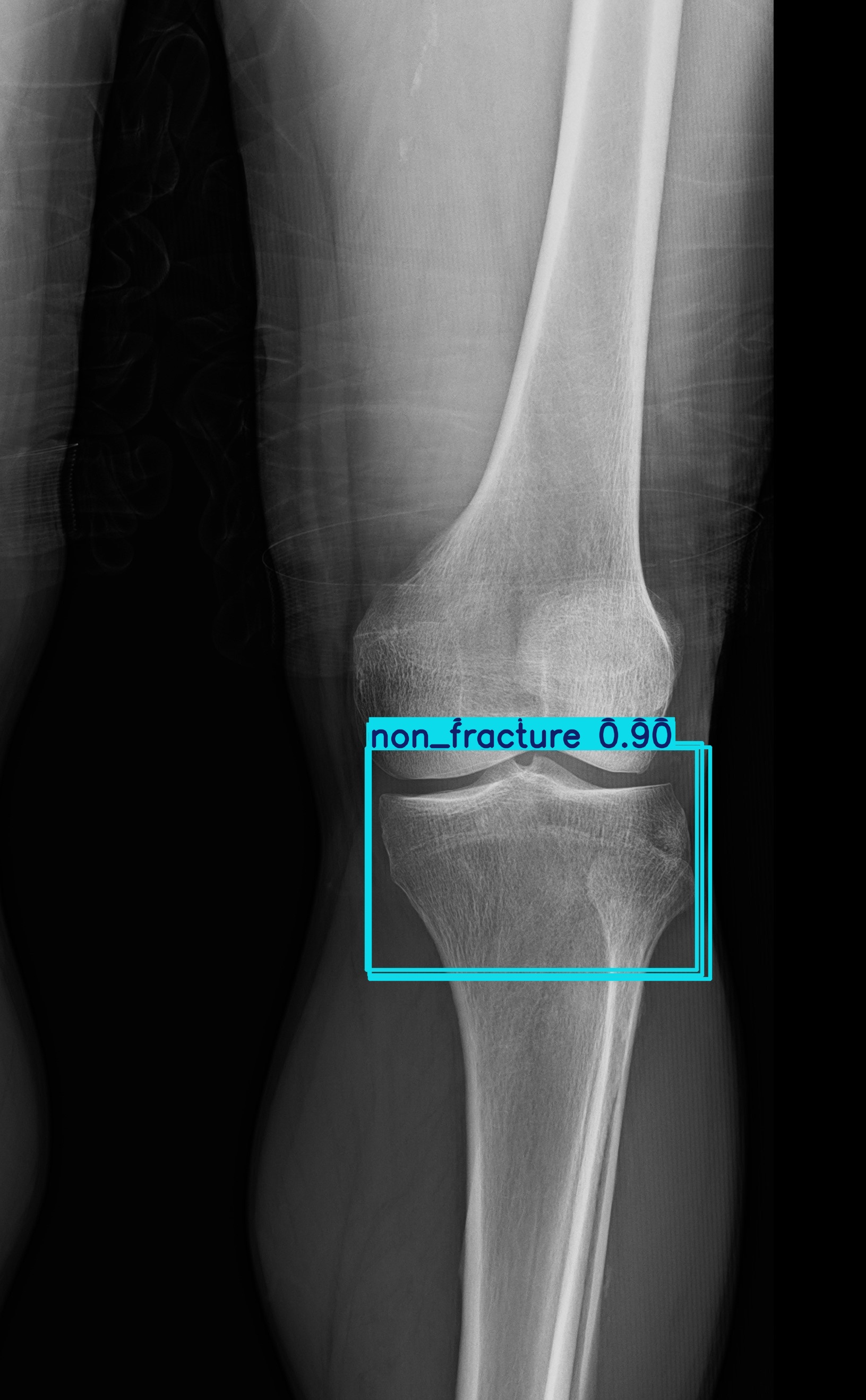 non_fracture_non_fracture_1 (4).jpg