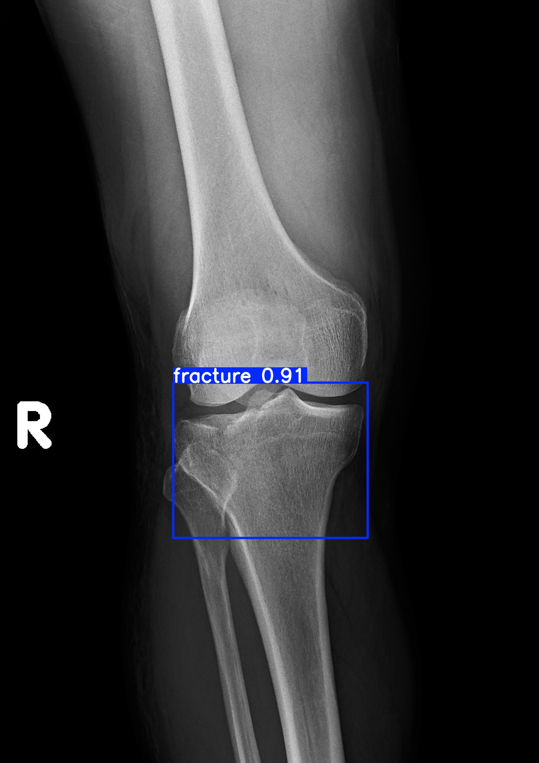 fracture_1.jpg